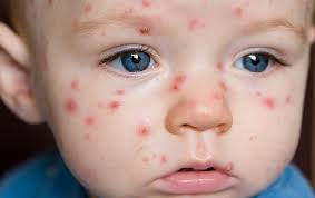 Bệnh Rubella là bệnh gì?